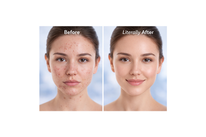 AcneX Natural Acne Removel